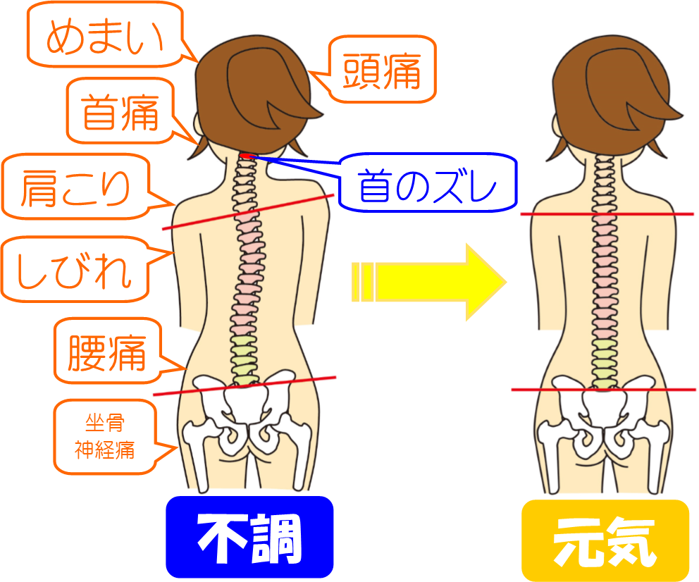 首のズレから頭痛・めまい・首痛・しびれ・腰痛・坐骨神経痛