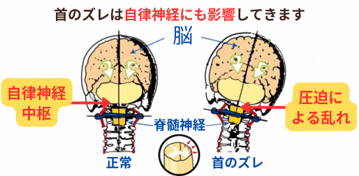 首のズレから自律神経失調症